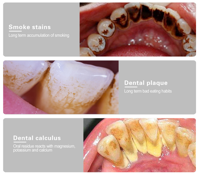 UltrasonicElectricDentalToothCleanerCleaningOralIrrigatorKitforTeethStainsPlaqueTeethWhiteningTeethC-1997986-4